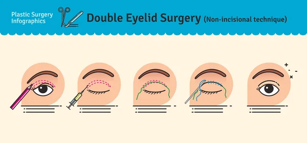 Vector Illustrated set met dubbele ooglid chirurgie. Non-incisional techniek — Stockvector