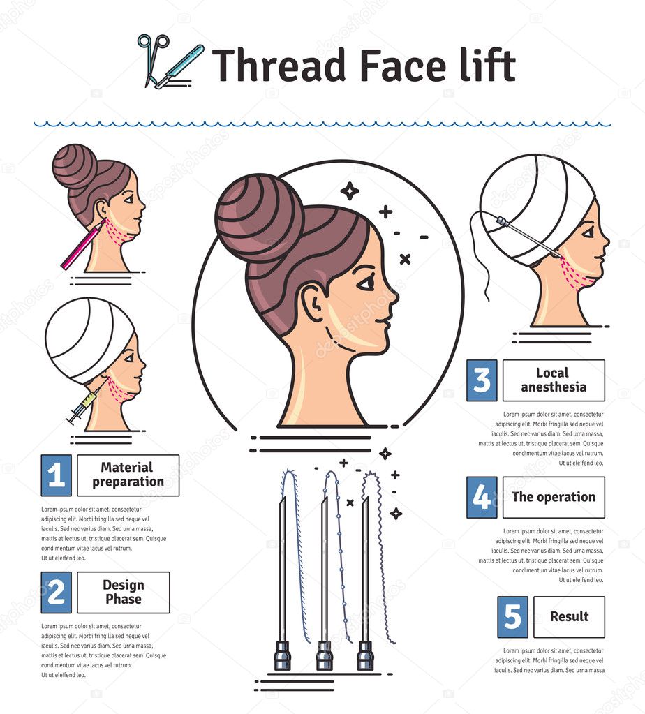 Vector Illustrated set with face lifting surgery by threads