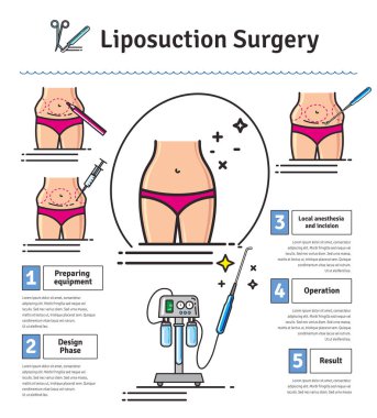 Vektör Illustrated liposuction cerrahi ile ayarla