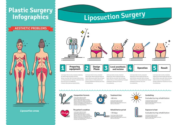 Vektör Illustrated liposuction cerrahi ile ayarla — Stok Vektör