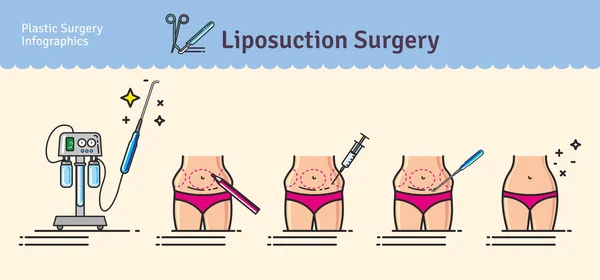 Conjunto ilustrado com cirurgia de lipoaspiração —  Vetores de Stock