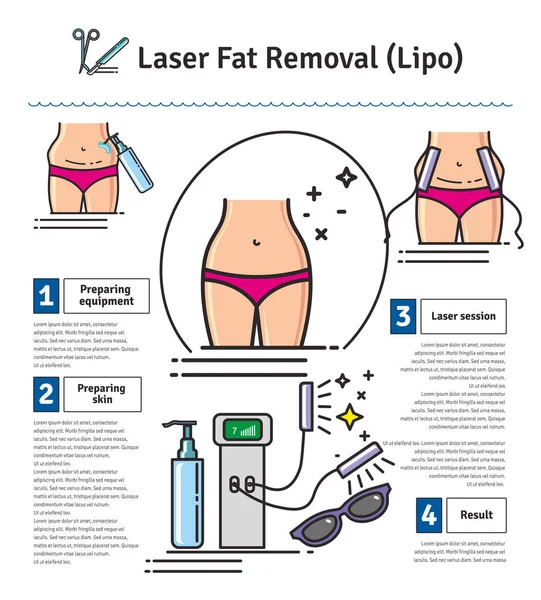 레이저 Lipo 지방 제거로 설정 하는 벡터 일러스트 — 스톡 벡터