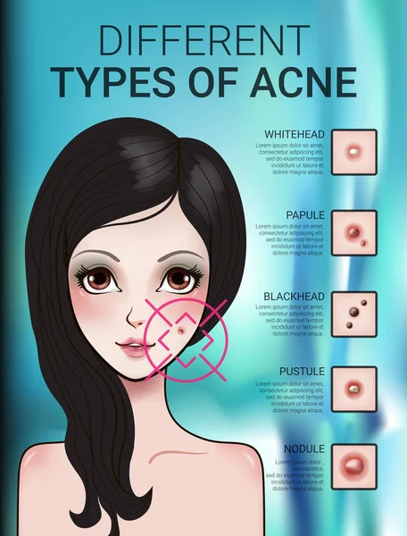 Infográficos de diferentes tipos de acne na pele —  Vetores de Stock