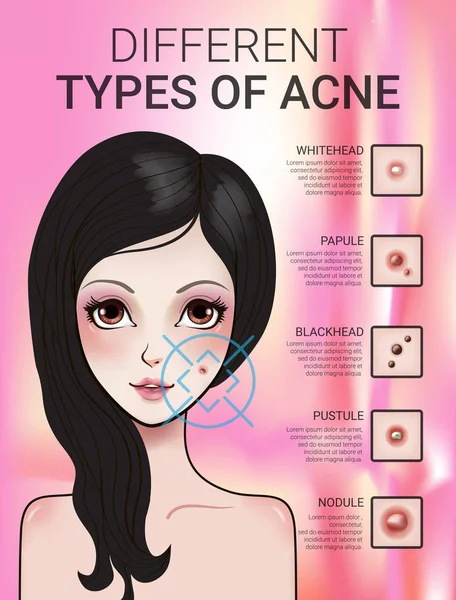 Infográficos de diferentes tipos de acne na pele — Vetor de Stock