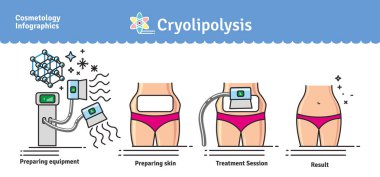 Vektör Illustrated kozmetik Cryolipolysis tedavi ile ayarla