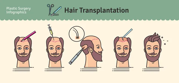 Vector Illustrated set with hair transplant surgery — Stock Vector