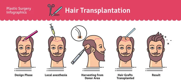 Vector Illustrated set dengan operasi transplantasi rambut - Stok Vektor