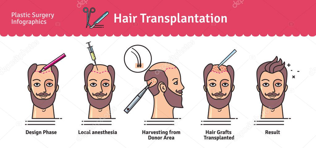 Vector Illustrated set with hair transplant surgery
