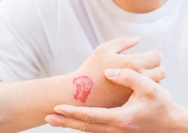 Mann zeigt nach Unfall Verletzungen oder Wunden am Arm — Stockfoto