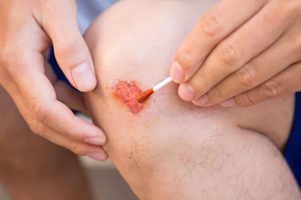 人用红色药物治疗膝部病变或伤口 — 图库照片