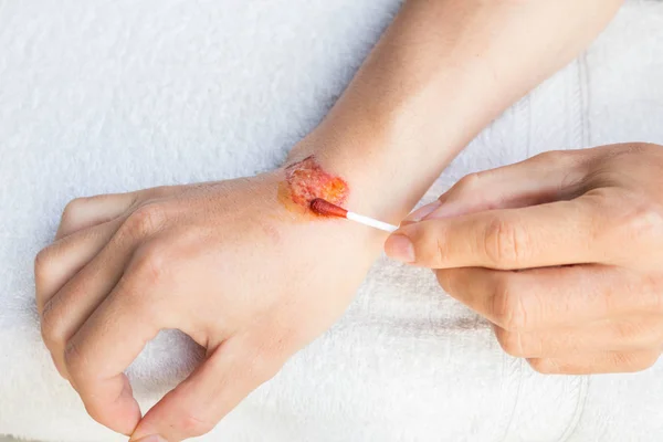 Man behandelen laesie of wond op zijn arm met rode geneeskunde — Stockfoto