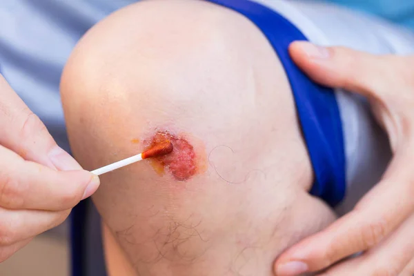 Hombre tratar lesión o herida en la rodilla con medicina roja — Foto de Stock