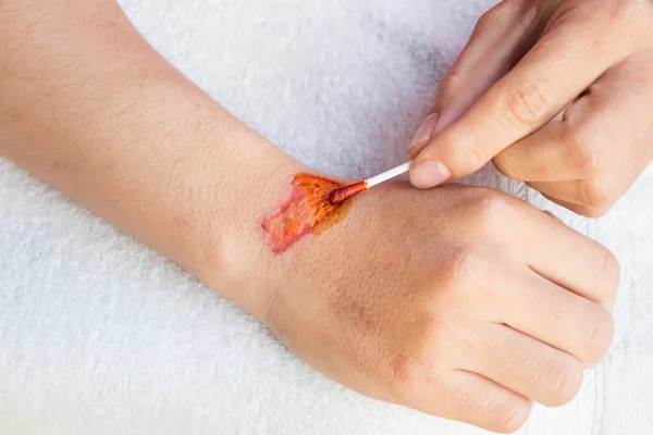 Hombre tratar lesión o herida en su brazo con medicina roja — Foto de Stock