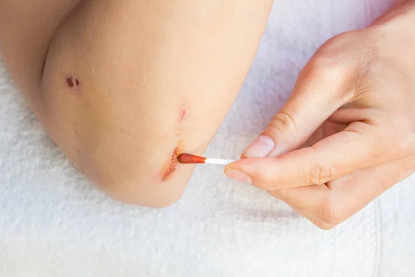 Hombre tratar lesión o herida en su brazo con medicina roja — Foto de Stock