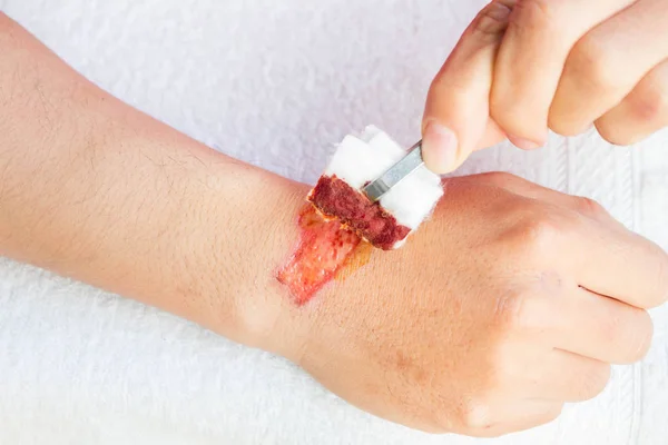 Mann behandelt Verletzung oder Wunde am Arm mit rotem Medikament — Stockfoto