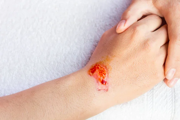 Adam Haritayı lezyon ya da kaza sonrası kolundaki yara