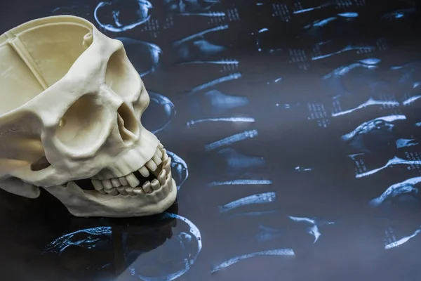 Radiografia Cranio Tac Che Mostra Frattura All Osso Frontale — Foto Stock
