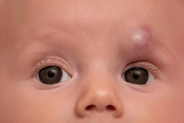 Hemangioma Infantil Testa Menina Tratamento Com Propranol — Fotografia de Stock