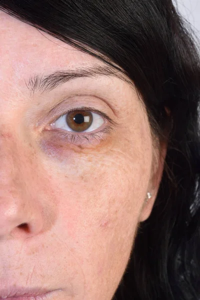 Bruise op een vrouw oog — Stockfoto