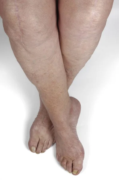 Шрам на ноге и колене пожилой женщины — стоковое фото