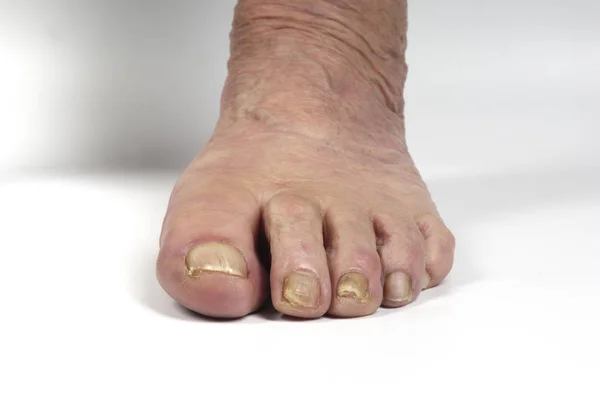 Anziano donna piede su bianco — Foto Stock