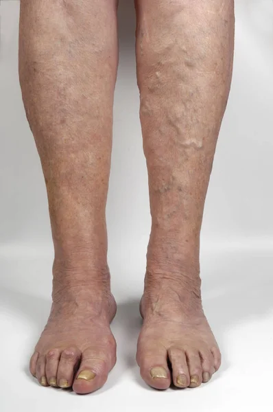 Venas varicosas en la pierna de una mujer , — Foto de Stock
