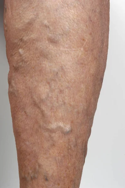 Varicose veins in the leg of a woman, — Stock Photo, Image