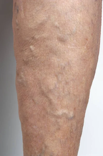 Varicose veins in the leg of a woman, — Stock Photo, Image