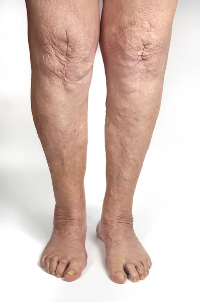 Нога пожилой женщины на белом — стоковое фото