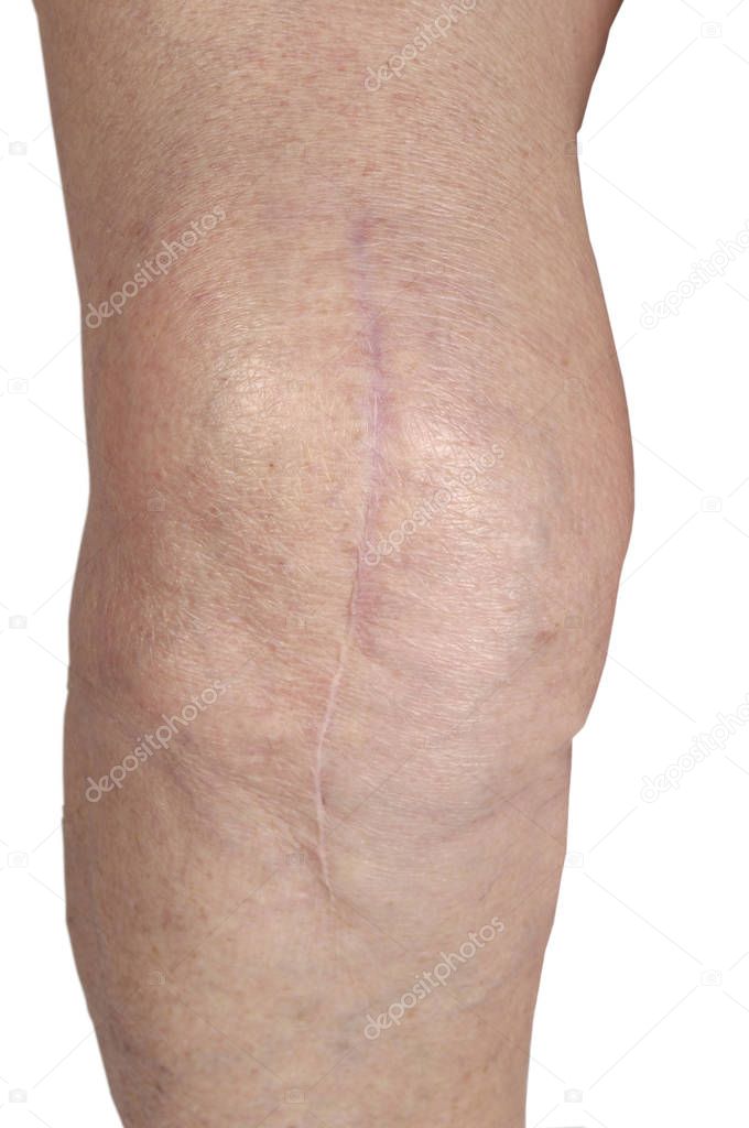 scar on the knee of an elderly woman,
