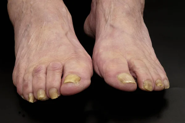 一个女人用指甲真菌的脚 — 图库照片