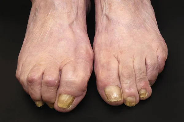 손톱 균 류와 여자의 발 — 스톡 사진