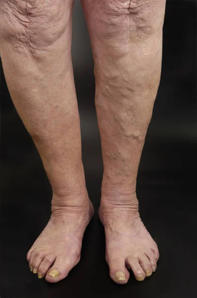 Venas varicosas en la pierna de una mujer , — Foto de Stock