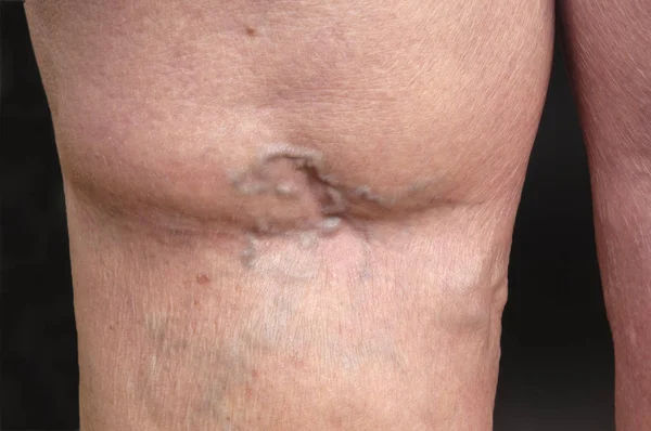 Varizes na perna de uma mulher , — Fotografia de Stock
