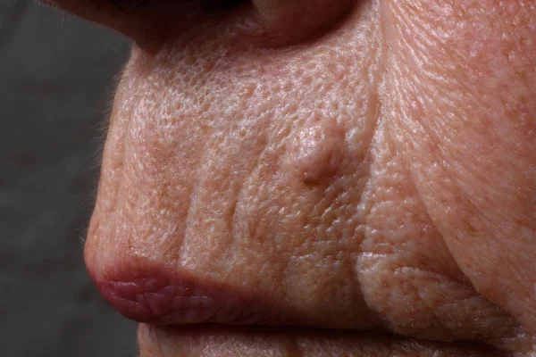 Närbild av en rynkor runt läpparna — Stockfoto
