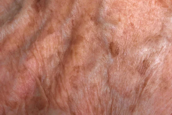 Texture and stains on the wrinkled hands of an elderly woman — Stock Photo, Image