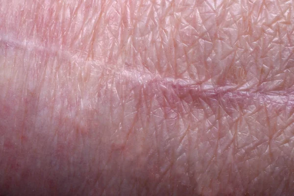 Velha cicatriz no joelho de uma mulher mais velha — Fotografia de Stock