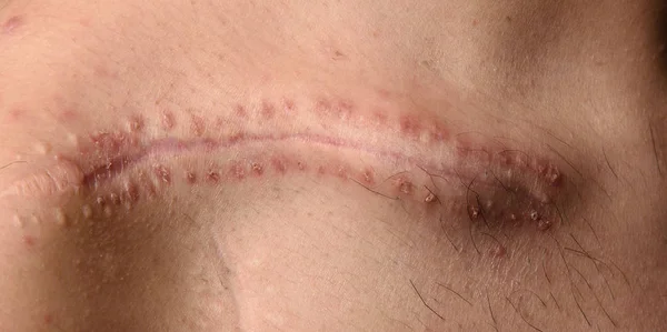 Detail of a scar on the clavicle — Stock Photo, Image