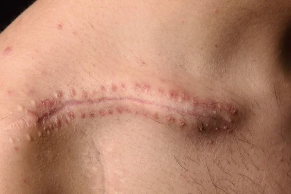 Dettaglio di una cicatrice sulla clavicola — Foto Stock