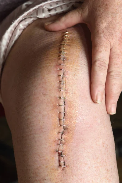 Ferida após uma operação de prótese de joelho — Fotografia de Stock