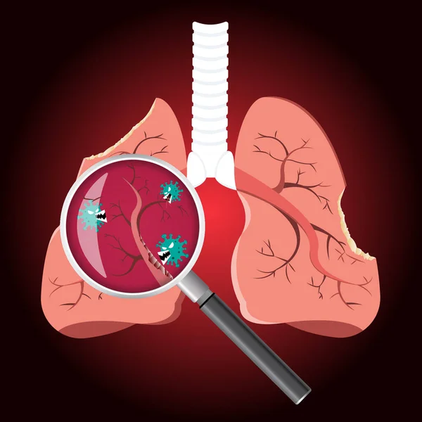 Повреждены Коронавирусными Клетками Увеличительным Стеклом Осматривающим Пораженные Легкие Covid Страшным — стоковый вектор