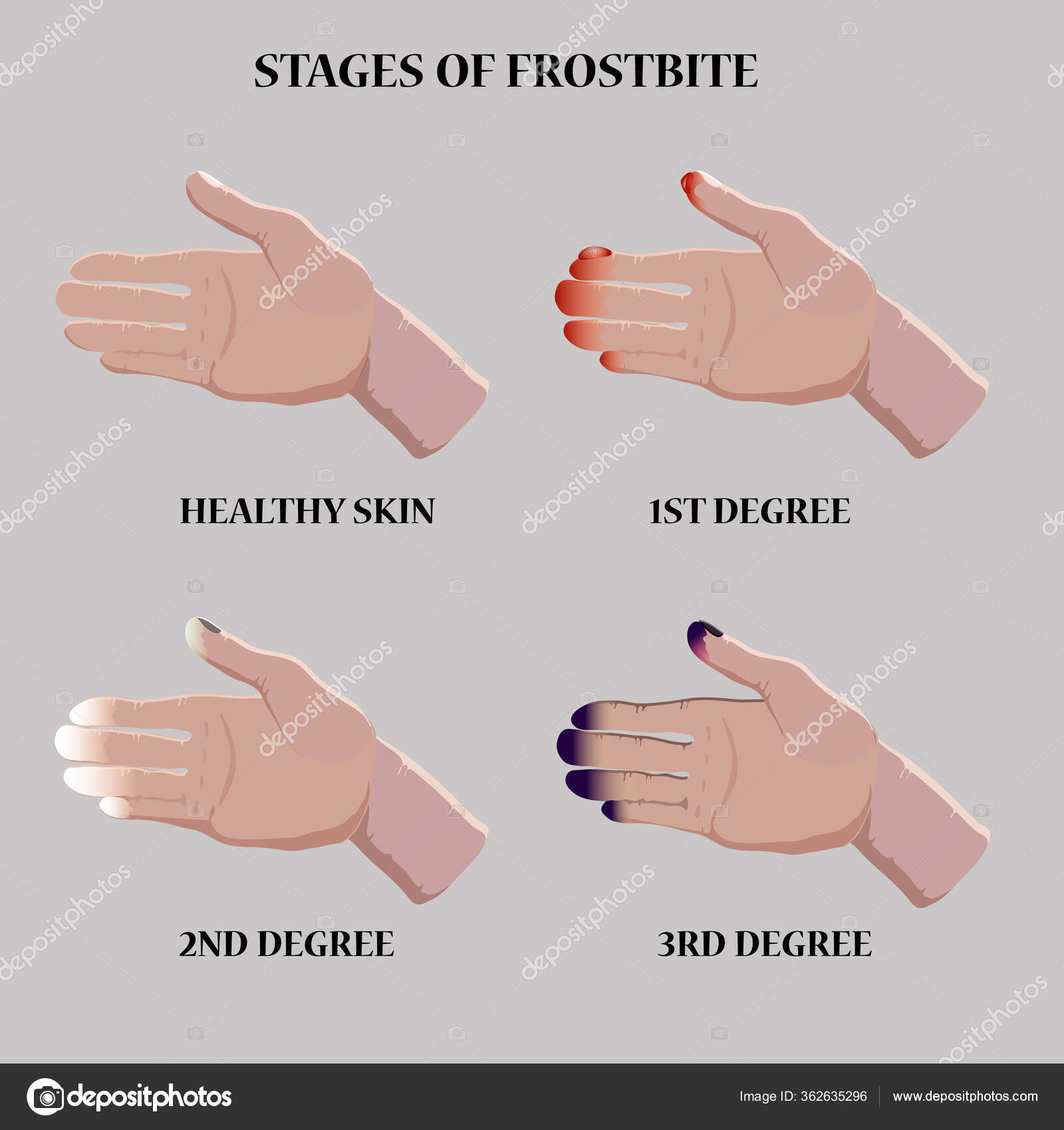 Frostbitten Fingers Gloves