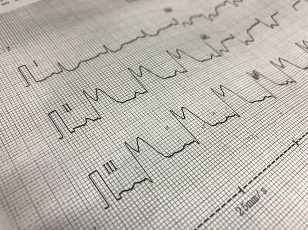 ST elevation on ECG paper — Stock Photo, Image