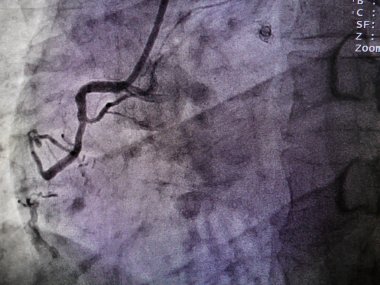 STEMI at right coronary artery clipart