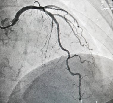 Left anterior descending artery clipart