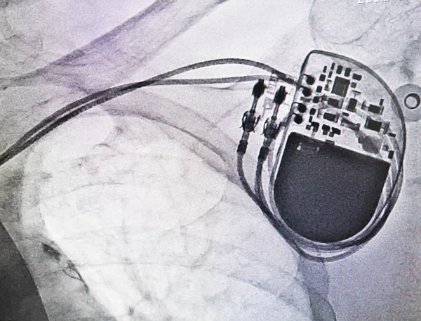 X-ray pacemaker