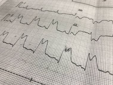 ST elevasyonu EKG kağıt üzerinde