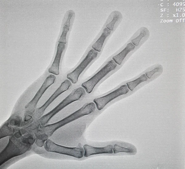 Hand x-ray