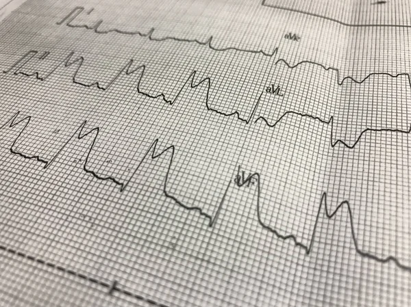 ST elevação no papel ECG Fotografias De Stock Royalty-Free