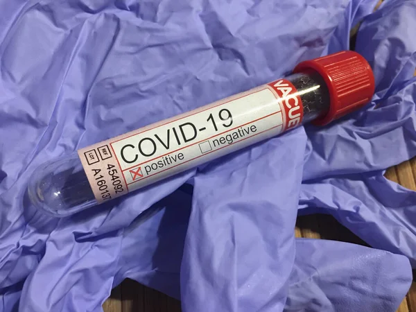 Coronavirus Positive Diagnosis Covid Virus Test Tube — стокове фото